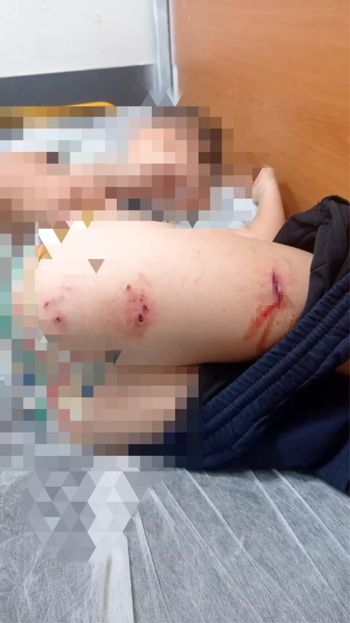 Sokak Köpekleri 9 Yaşındaki Çocuğu Isırdı