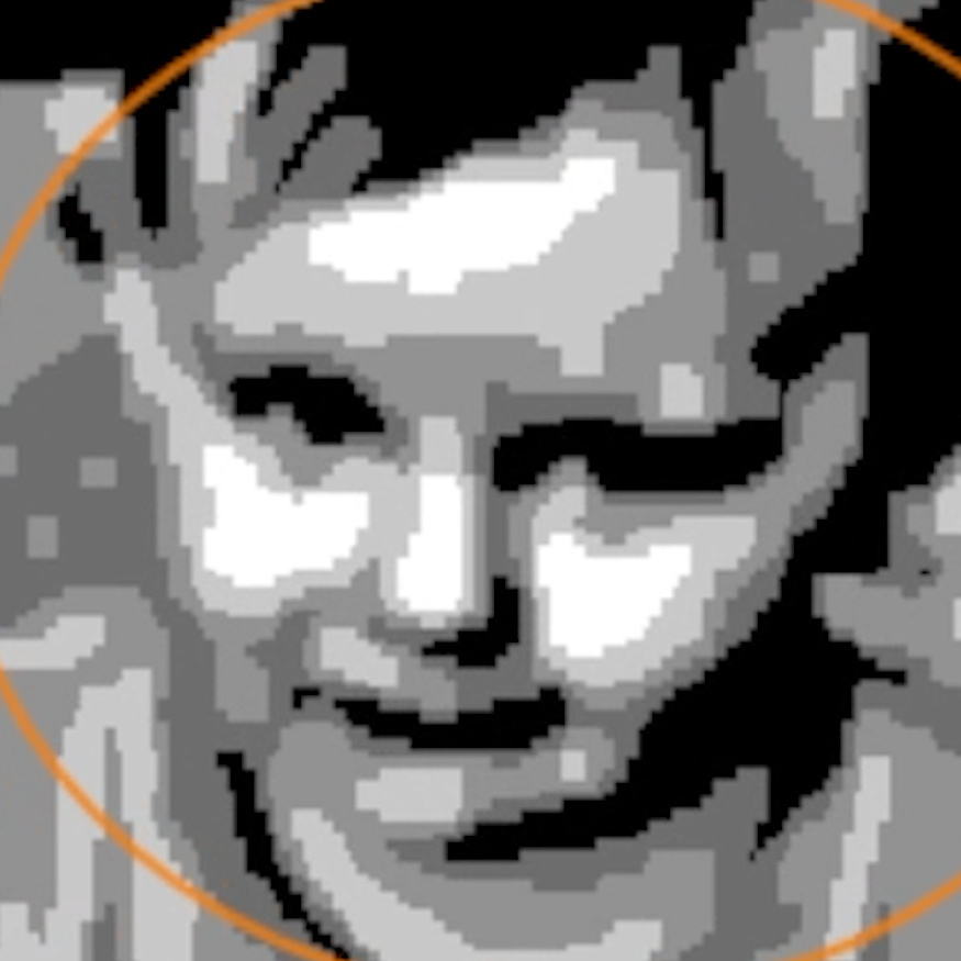 Vision Restored Using Prosthetic Retinal Implant