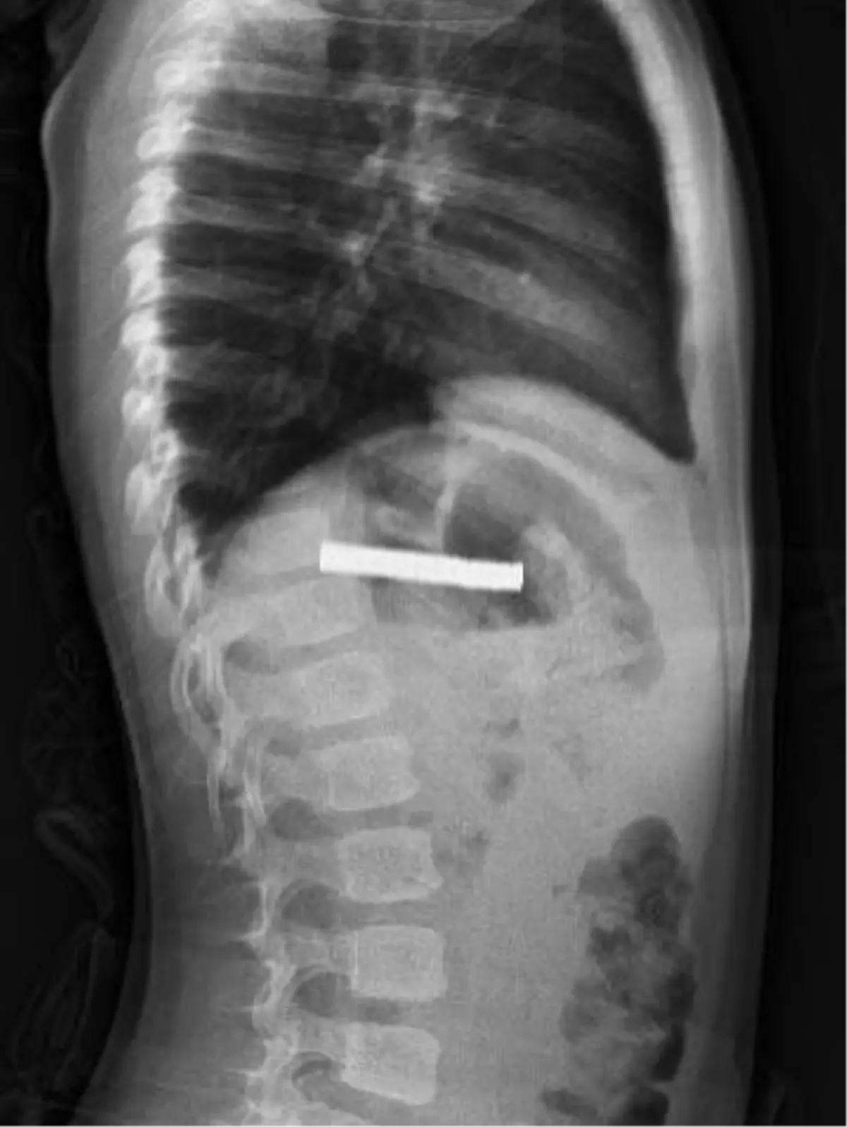 Mıknatıs Krizi: 3 Yaşındaki Çocuğun İnanılmaz Macerası