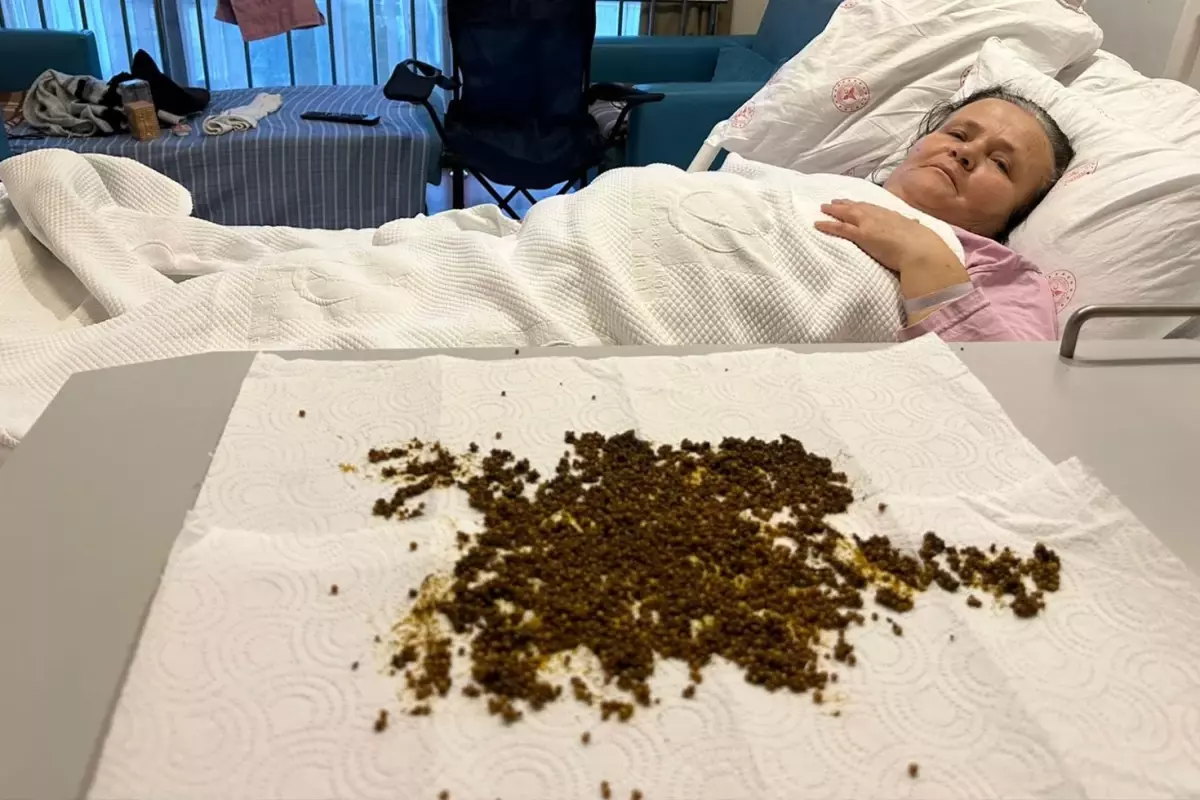 Karın Ağrısı Şikayetiyle Gitti, Safra Kesesinden 20 Binin Üzerinde Taş Çıkarıldı