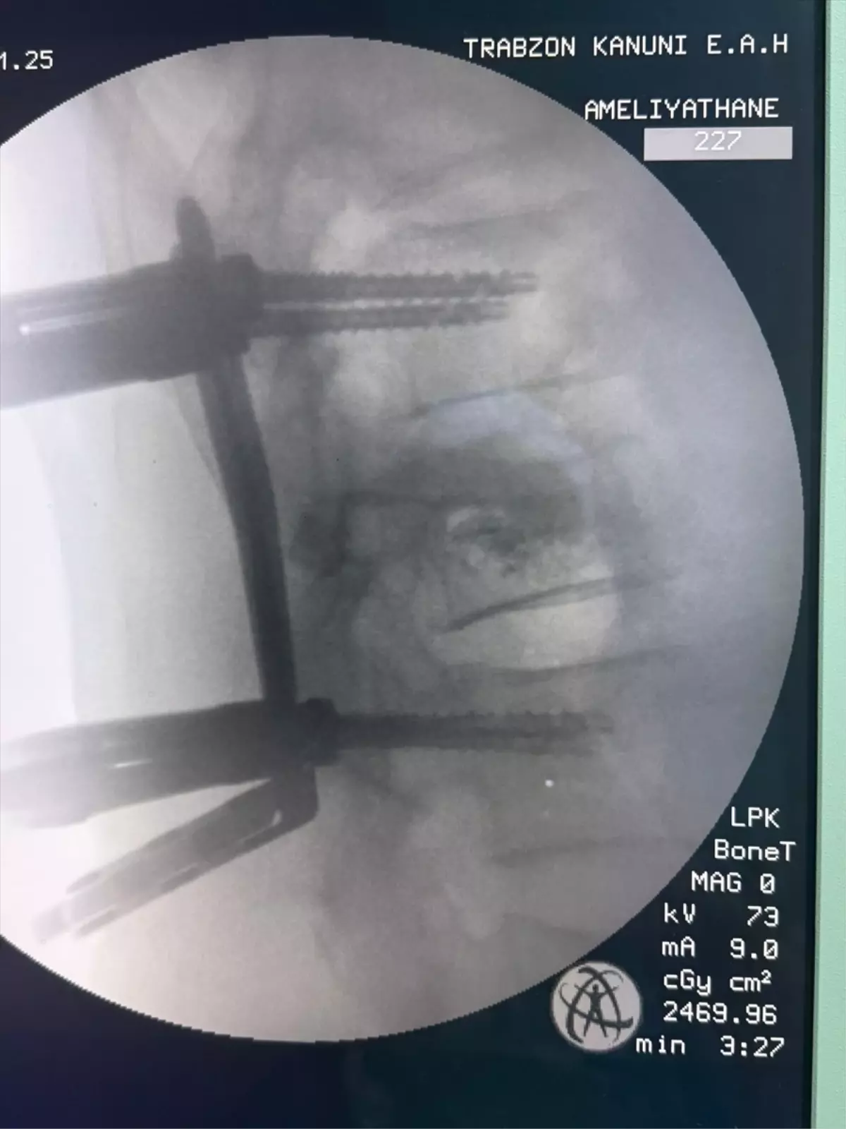 Omurga Vidalama Ameliyatı Kanuni Hastanesi’nden Başarıyla Gerçekleşti