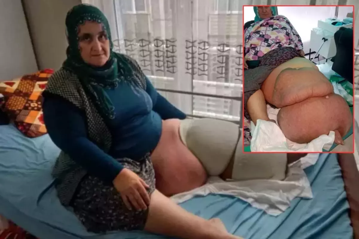35 Yıldır Aynı Hastalıkla Mücadele Ediyor! Bacağının Ağırlığı 100 Kiloya Kadar Çıktı